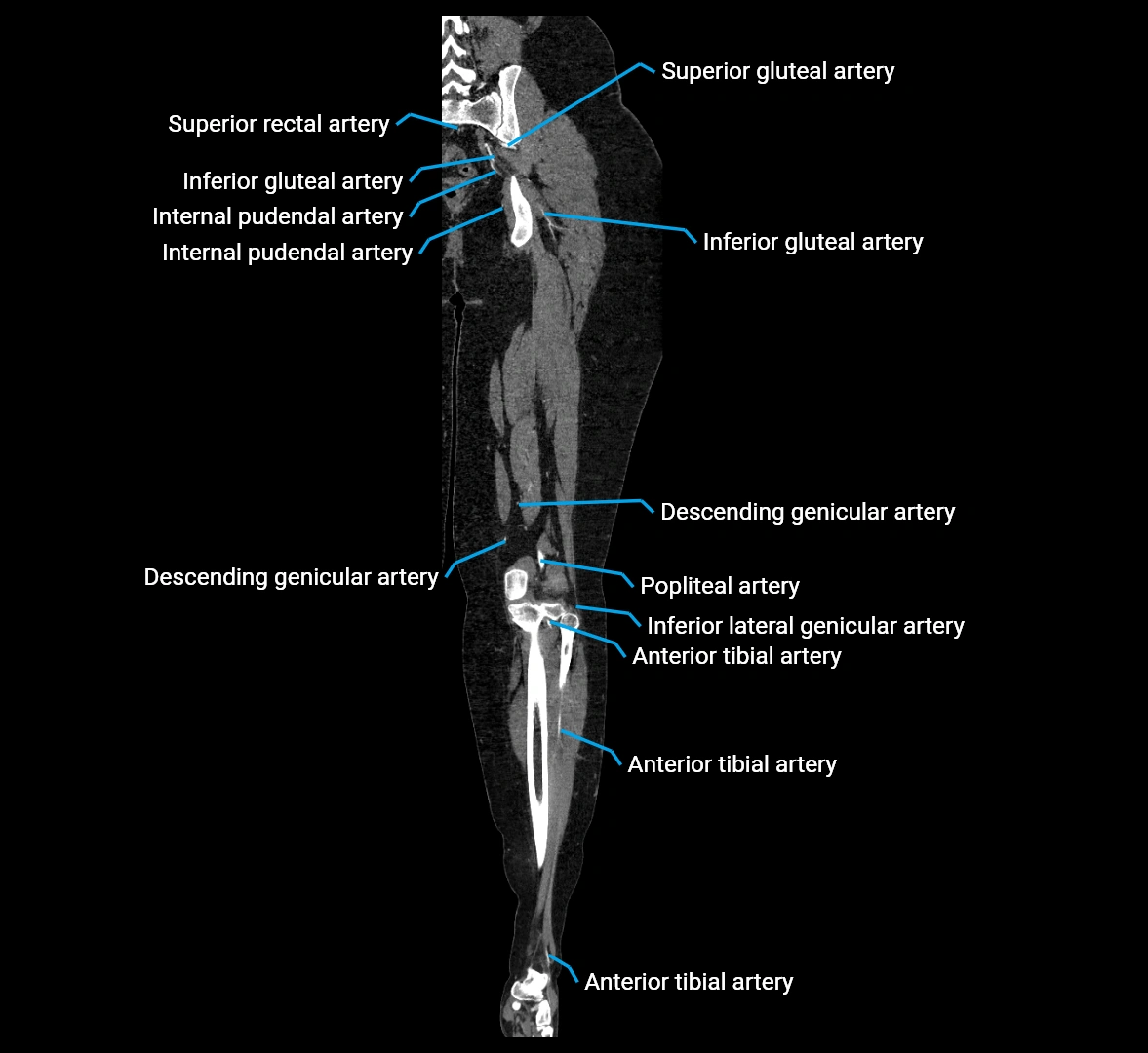 CTA lower limb coronal cross sectional anatomy labelled image _57 (2).webp
